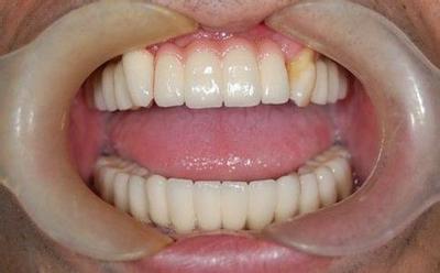 牙周病患者种植修复